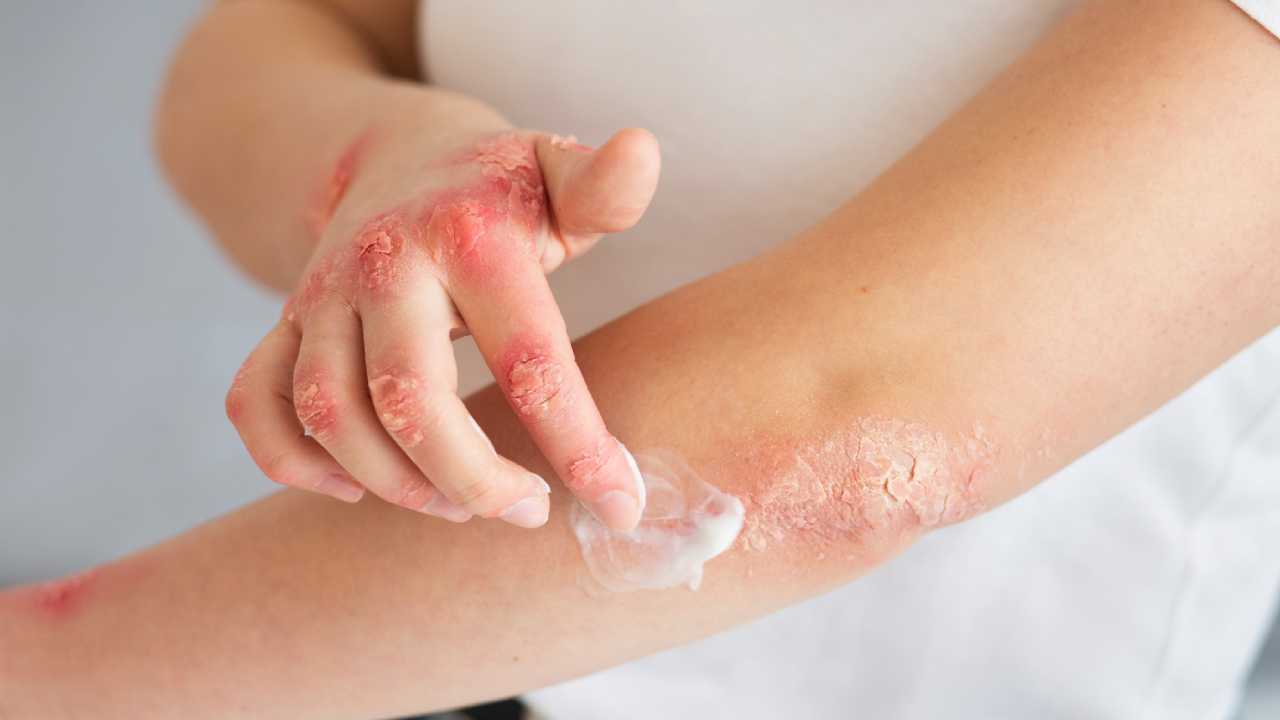 Burn Injuries